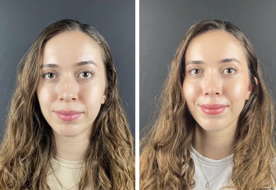 Rhinoplasty before and after front view - Dr. Rasit Cevizci Istanbul