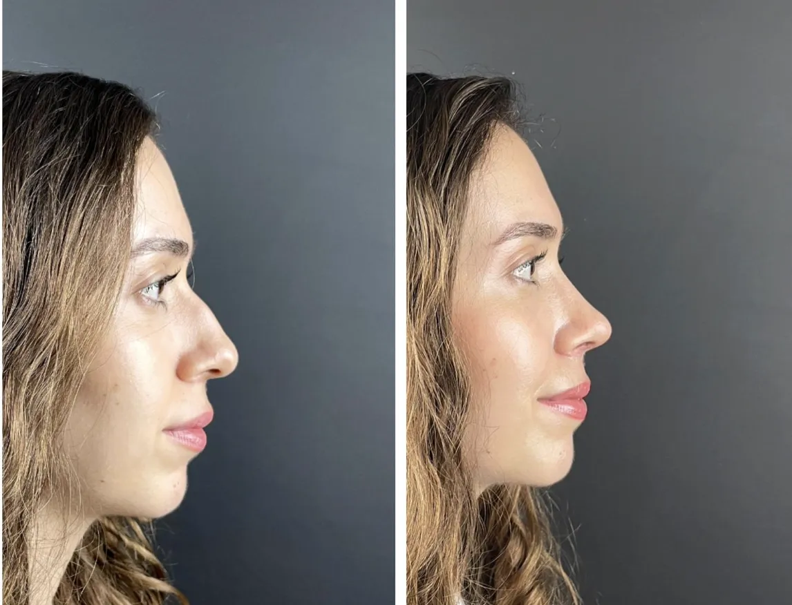 Nose job side profile before after - rhinoplasty result Turkey