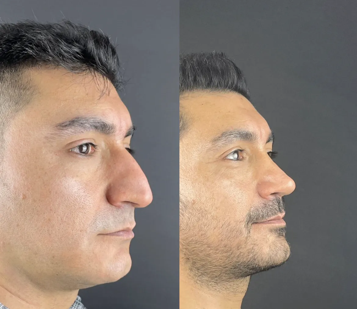 Male rhinoplasty before and after - nose surgery Istanbul