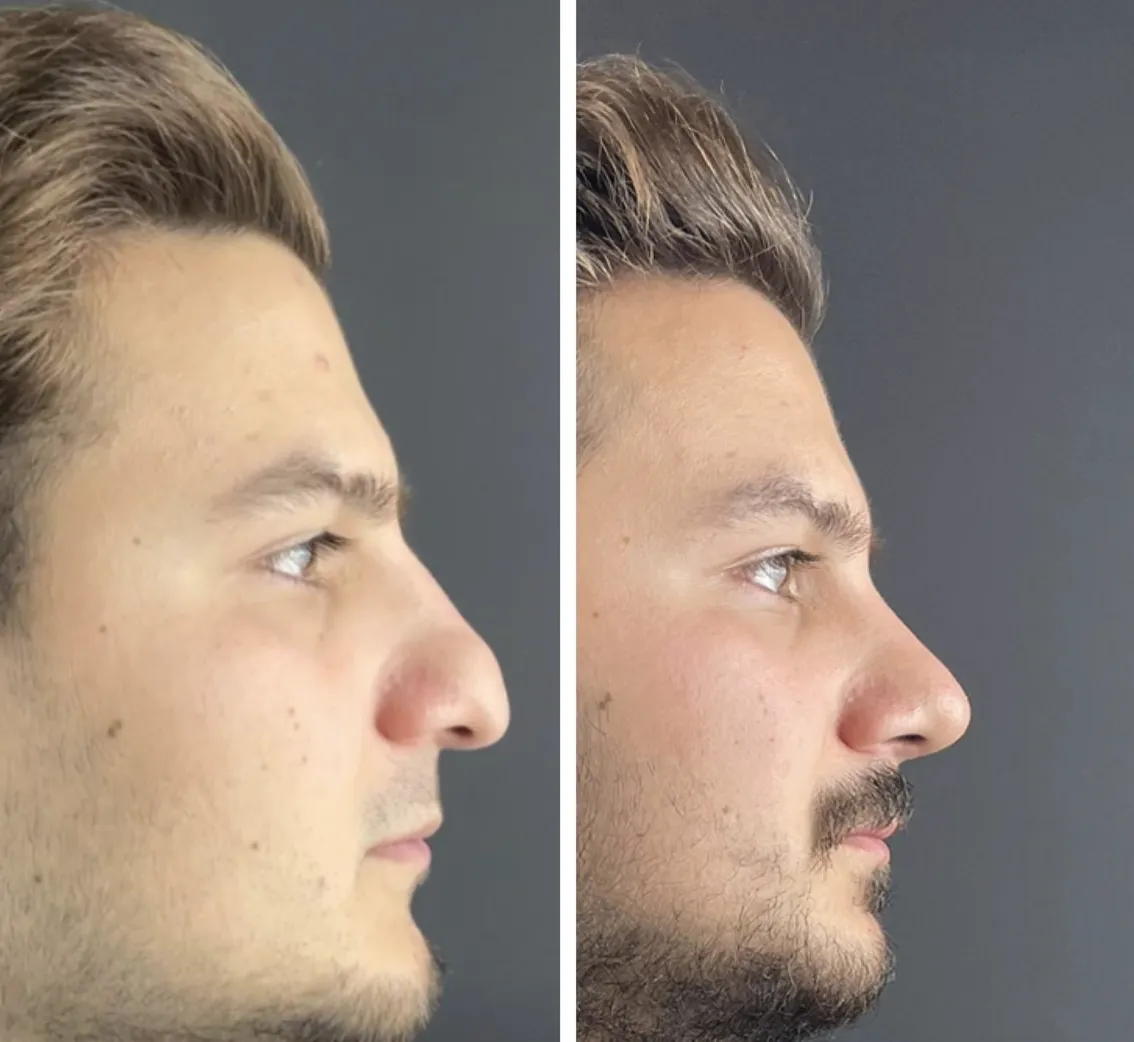 Dorsal hump removal rhinoplasty before after - nose job Istanbul