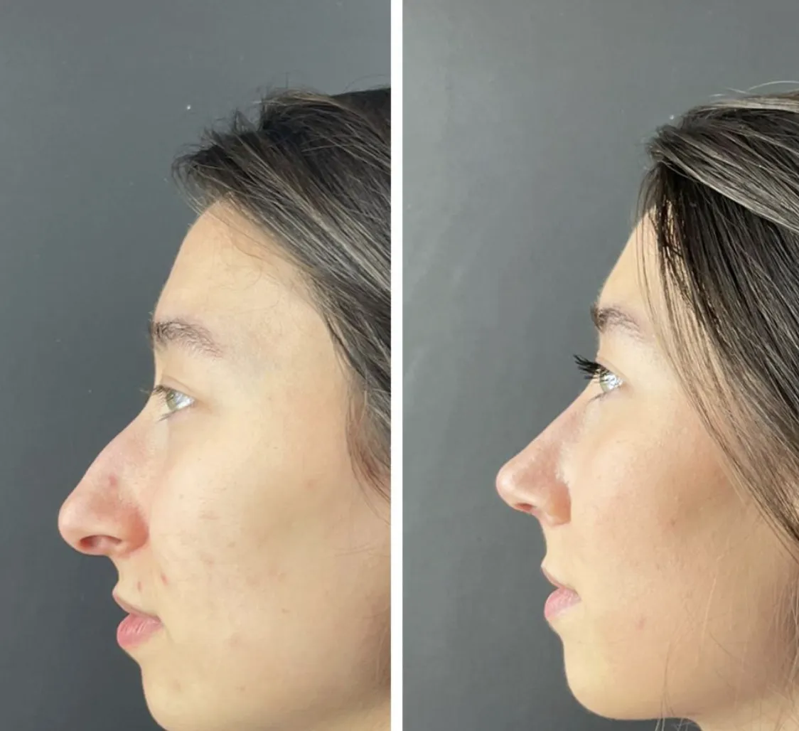 Nose tip refinement before and after - rhinoplasty Dr. Rasit Cevizci